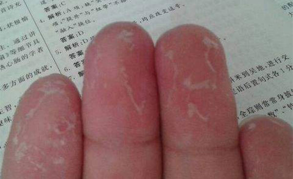 ��ָ��Ƥ��ʲôԭ�� ������ָ��Ƥ�ĳ���ԭ��